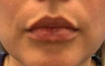 Lip Filler 13 After